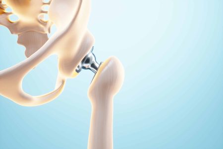 Medical poster image of a hip implant. artificial joint, Arthritis, inflammation, fracture, cartilage. 3D illustration, 3D render